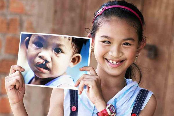 Thông báo chương trình Phẫu thuật dị tật vùng hàm mặt